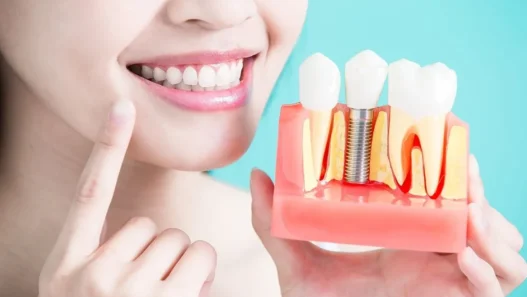 Dental Implants 101