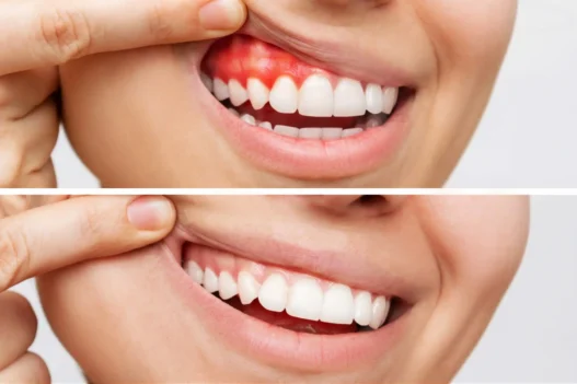Periodontal Care During And After Orthodontic Treatment