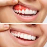 Periodontal Care During And After Orthodontic Treatment