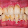 How To Protect Your Teeth From Gum Disease And Decay