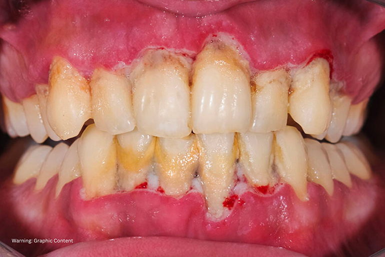 How To Protect Your Teeth From Gum Disease And Decay