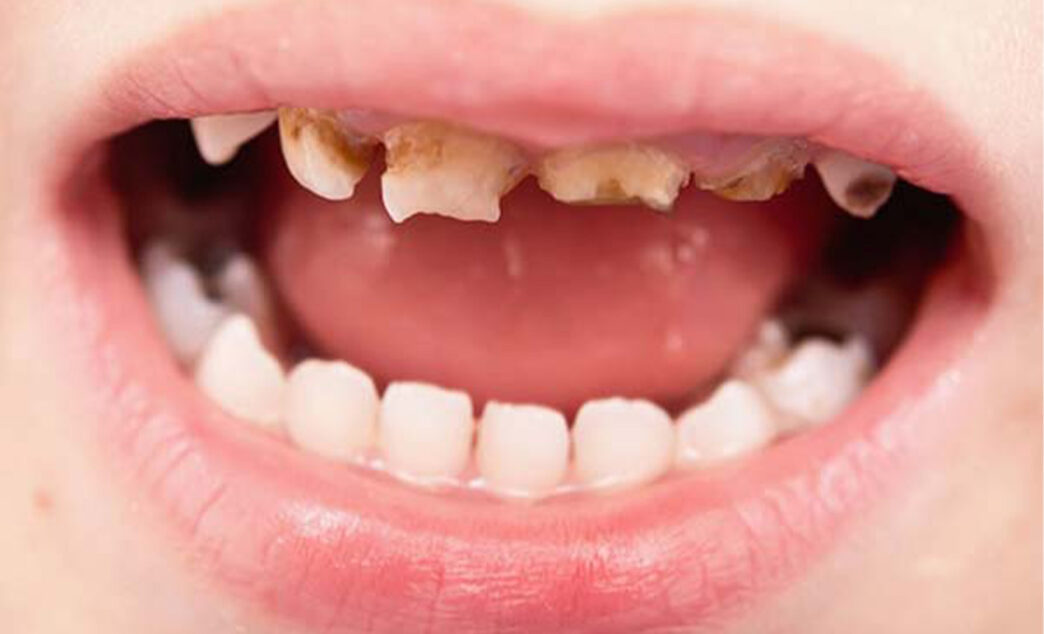 Common Dental Problems In Children And How To Prevent Them