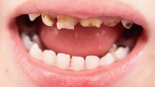 Common Dental Problems In Children And How To Prevent Them