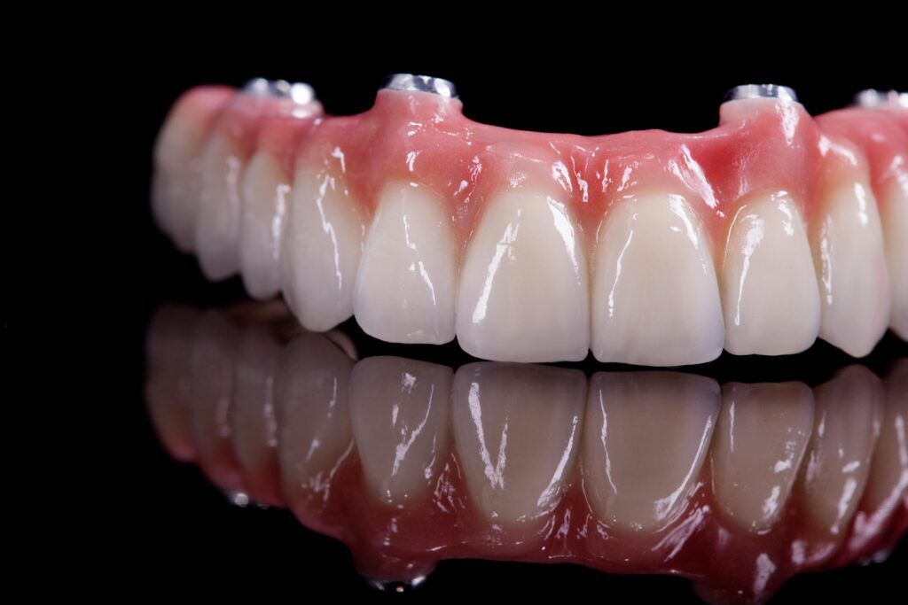 Implant Supported Prosthetics