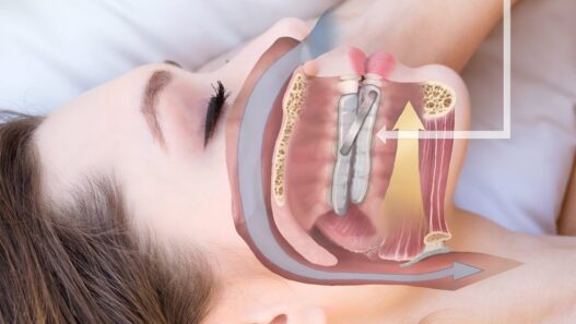 Oral Appliance Therapy