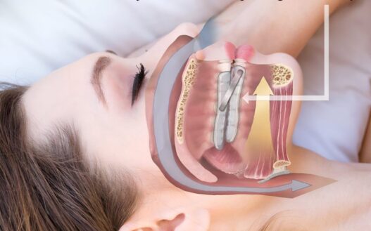 Oral Appliance Therapy