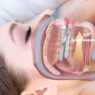 Oral Appliance Therapy
