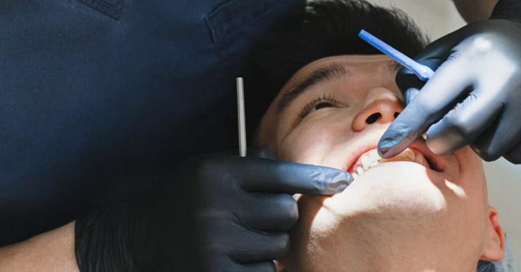 Early Cavity Detection