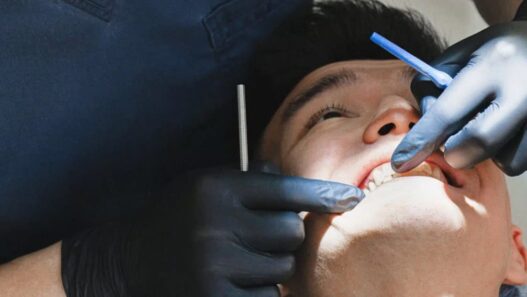 Early Cavity Detection