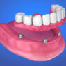 Dentures Vs. Dental Implants