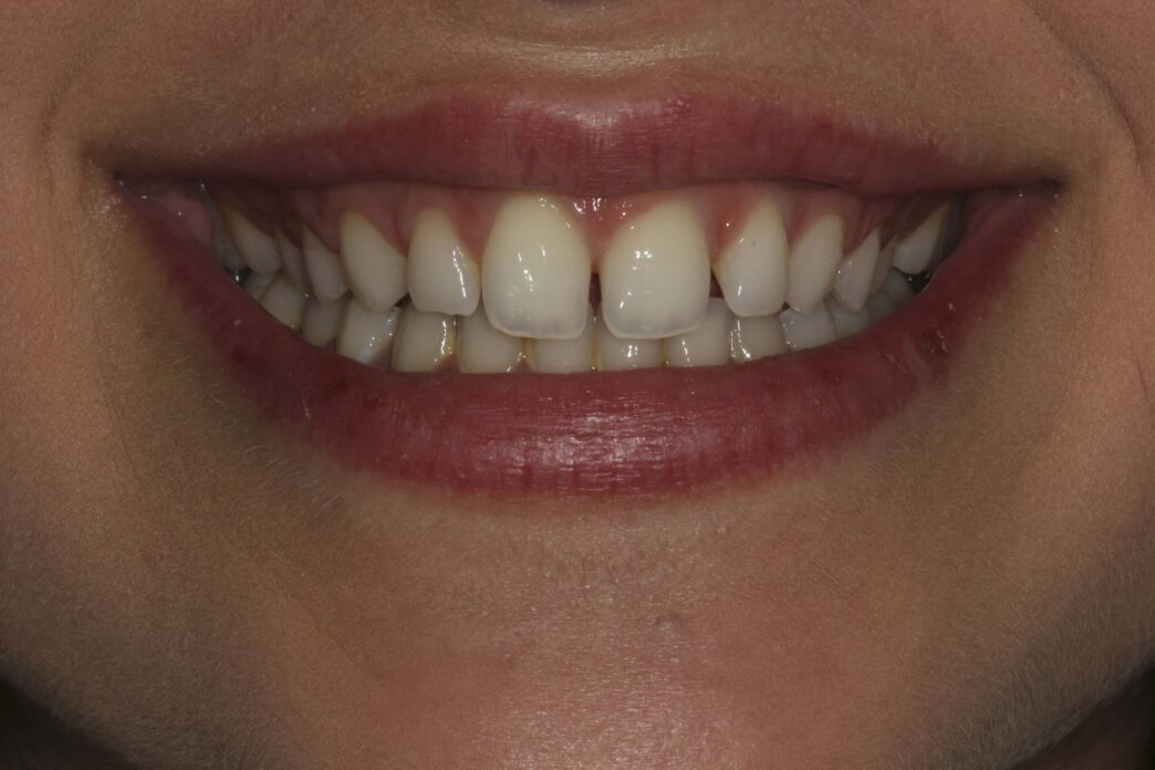 Porcelain Veneers Vs Bonding Which Option Lasts Longer