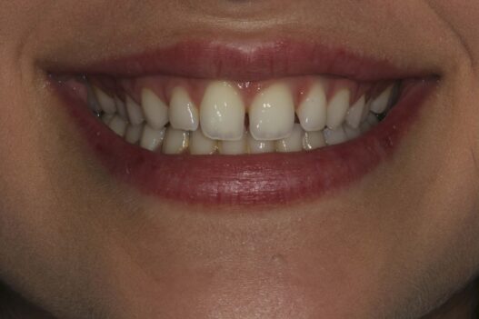 Porcelain Veneers Vs Bonding Which Option Lasts Longer