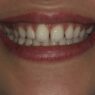 Porcelain Veneers Vs Bonding Which Option Lasts Longer