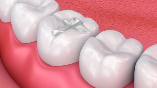 Dental Restorations