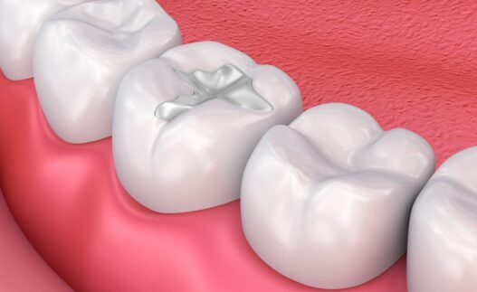 Dental Restorations