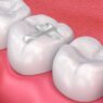 Dental Restorations