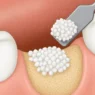 Bone Grafting