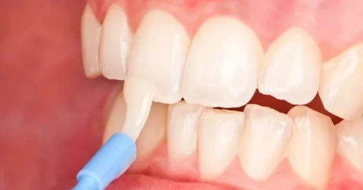 Fluoride Varnish Treatment