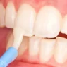 Fluoride Varnish Treatment