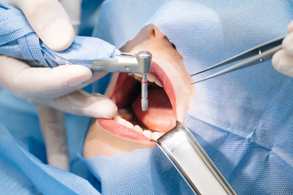 Oral Surgery In Implant Dentistry
