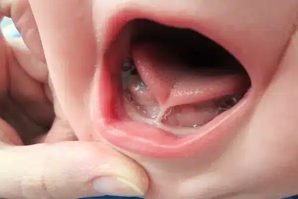 Tongue‑Tie Assessments