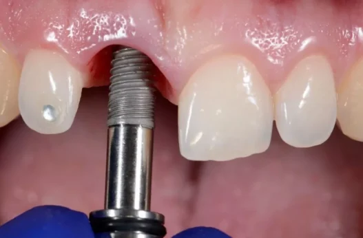 Dental Implant Surgery