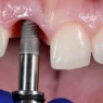 Dental Implant Surgery