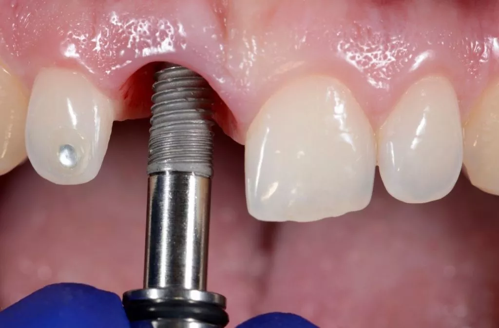 Dental Implant Surgery
