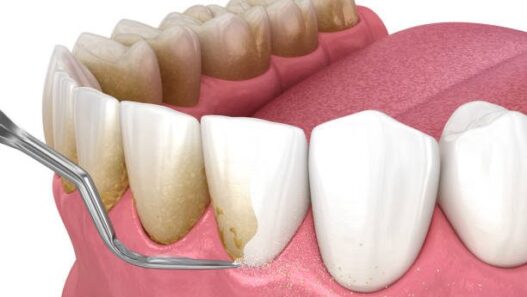 Orthodontics On Long Term Gum Health