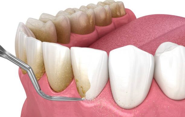 Orthodontics On Long Term Gum Health
