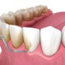 Orthodontics On Long Term Gum Health