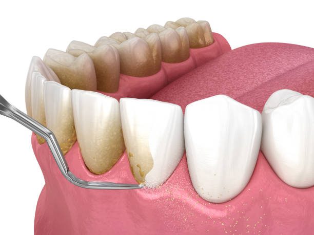 Orthodontics On Long Term Gum Health