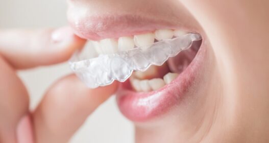Retainers After Treatment