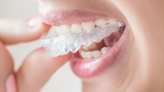 Retainers After Treatment