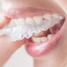 Retainers After Treatment