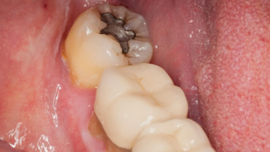 Early Signs Of Cavity Formation