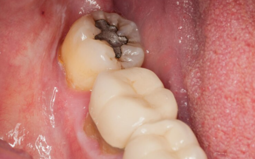 Early Signs Of Cavity Formation