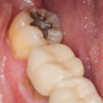 Early Signs Of Cavity Formation