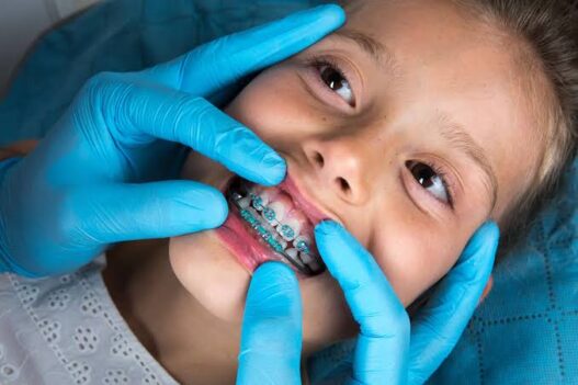Kids And Braces