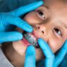 Kids And Braces