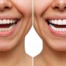 Choosing Between Cosmetic Enhancement And Functional Repair For A Damaged Tooth