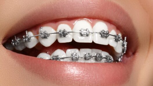Orthodontic Treatments