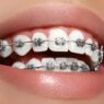 Orthodontic Treatments