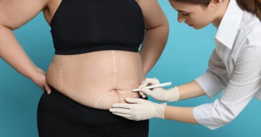 The Medical Screening That Happens Before Lipo Gets Approved